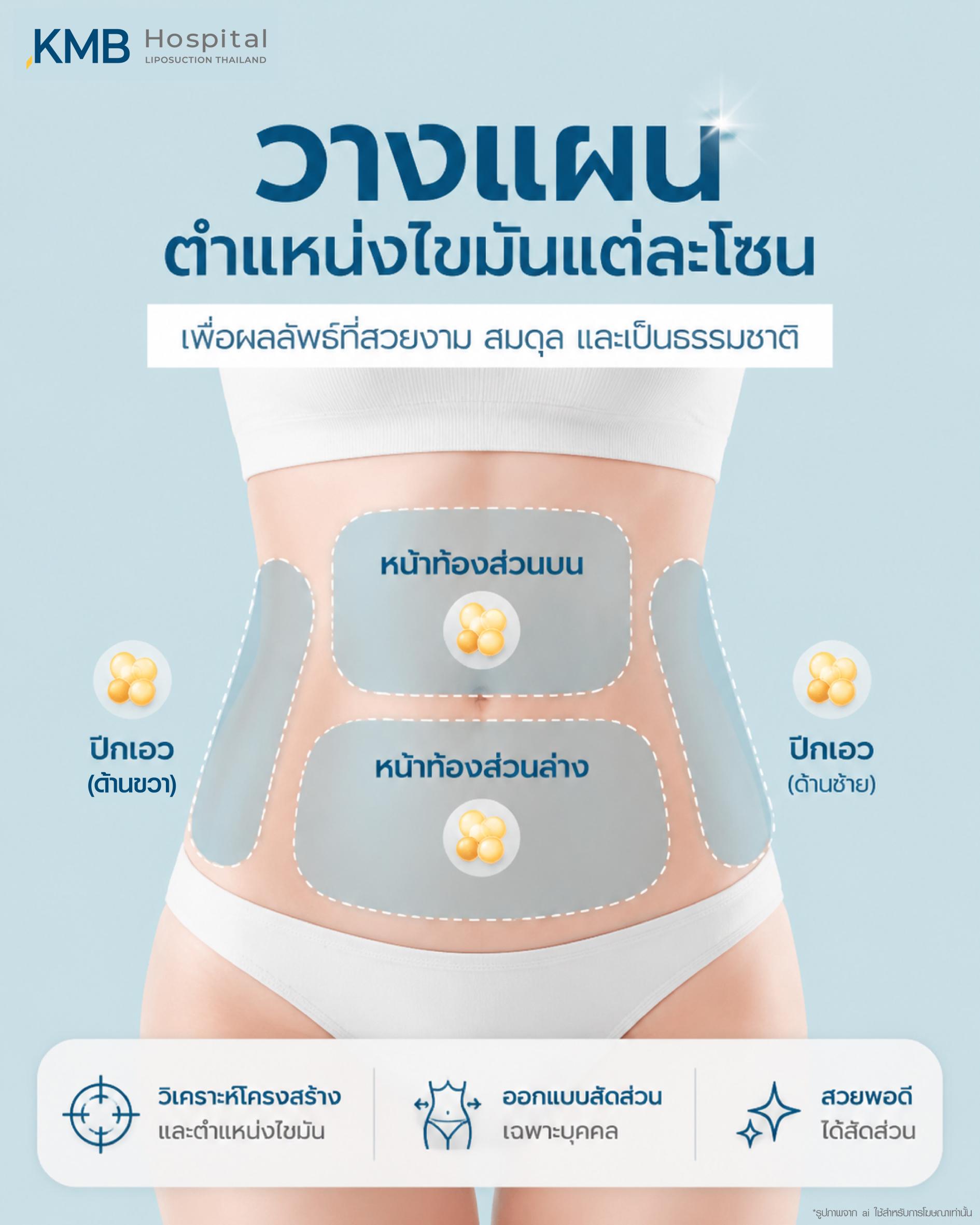 ภาพแสดงการวางแผนตำแหน่งไขมันแต่ละโซนบนหน้าท้องสำหรับโปรแกรมดูดไขมัน GLAM Liposculpt™ ที่ KMB Hospital เพื่อผลลัพธ์สมดุลและเป็นธรรมชาติ
