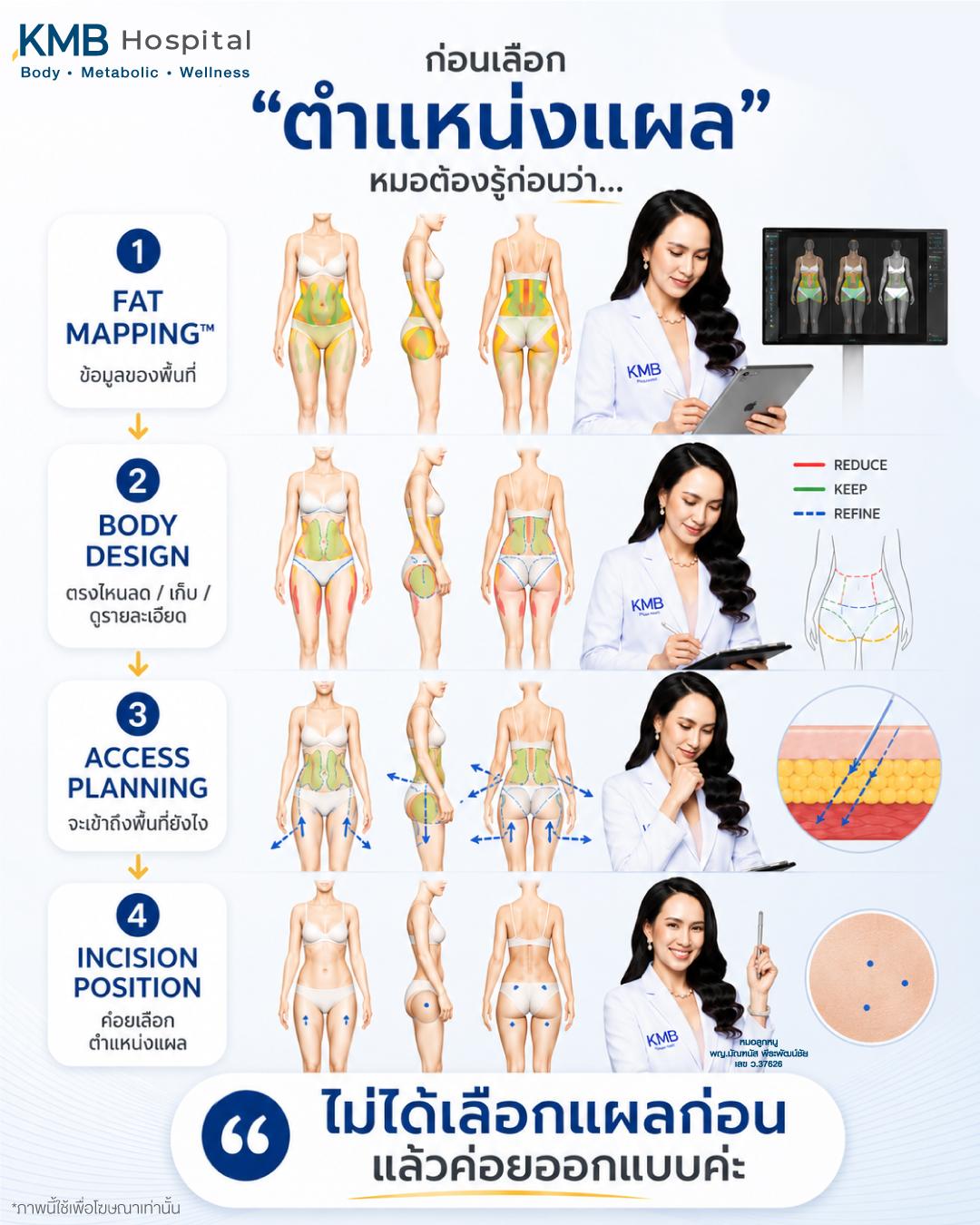 ภาพอธิบายลำดับจาก FAT Mapping™ และ Body Design ไปสู่การวางตำแหน่งแผลก่อนดูดไขมัน