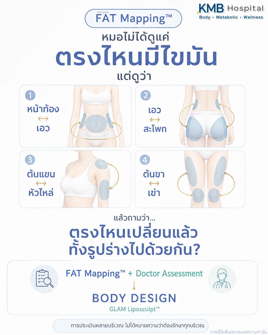 ภาพ FAT Mapping™ อธิบายความสัมพันธ์ของหน้าท้อง เอว สะโพก แขน และขาก่อนวางแผนดูดไขมัน