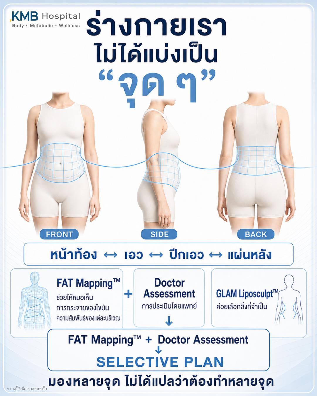 ภาพ FAT Mapping™ แสดงความสัมพันธ์ของหน้าท้อง เอว ปีกเอว และแผ่นหลังก่อนวางแผนดูดไขมัน