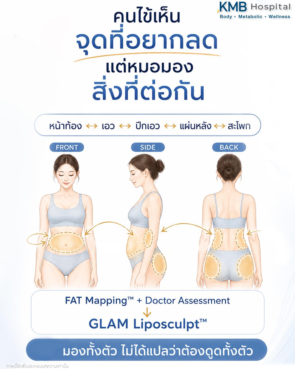 ภาพ FAT Mapping™ แสดงความสัมพันธ์ของหน้าท้อง เอว ปีกเอว แผ่นหลัง และสะโพกก่อนวางแผนดูดไขมัน