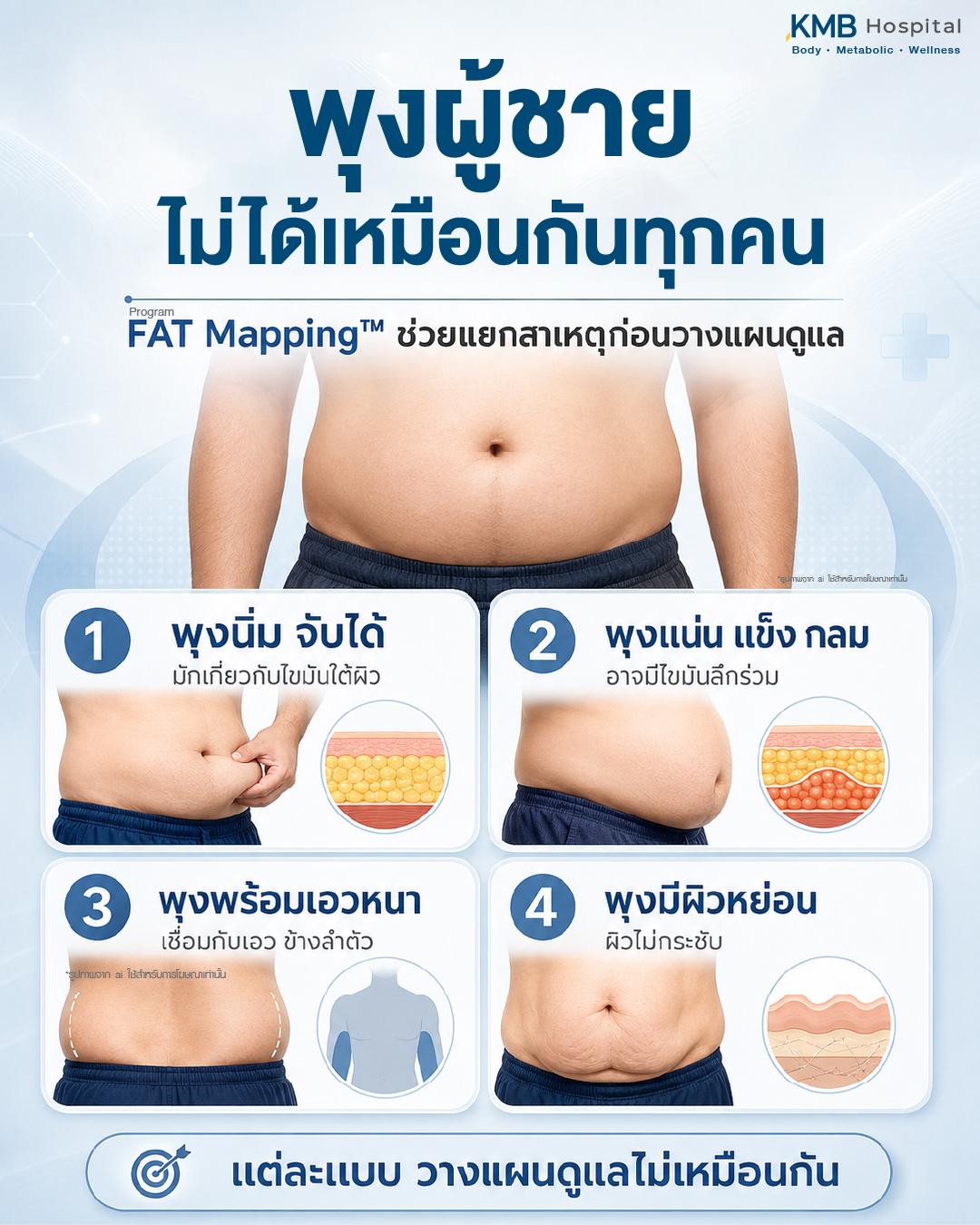 พุงผู้ชายไม่ได้เหมือนกันทุกคน โดยโปรแกรม FAT Mapping ช่วยแยกสาเหตุก่อนวางแผนดูแล เช่น พุงนิ่มที่มักเกี่ยวกับไขมันใต้ผิว พุงแน่นแข็งกลมที่อาจมีไขมันลึกร่วม พุงพร้อมเอวหนาที่เชื่อมกับเอวและข้างลำตัว หรือพุงที่มีผิวหย่อนและผิวไม่กระชับ เพื่อวางแผนดูแลรูปร่างให้เหมาะกับแต่ละบุคคล