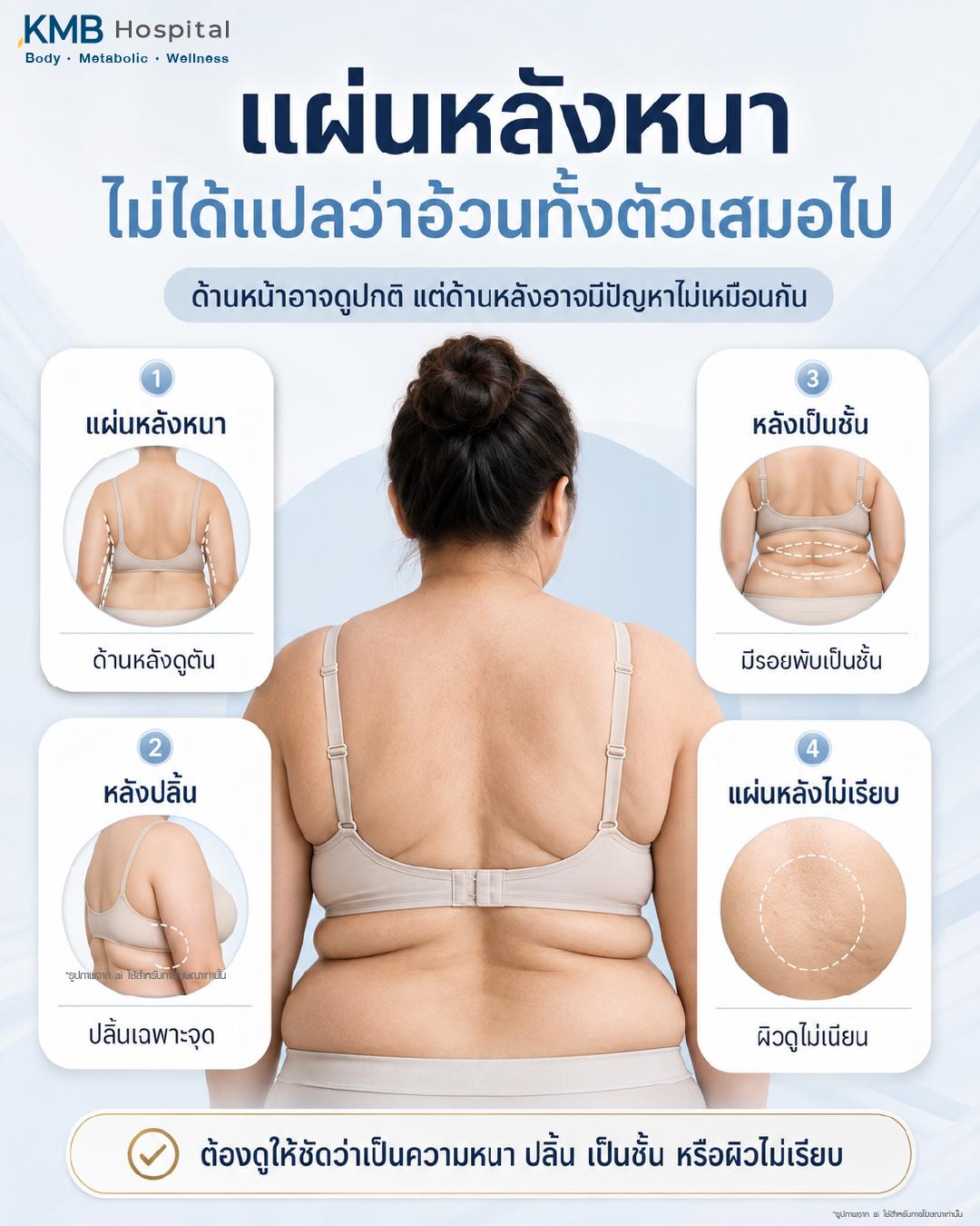 แผ่นหลังหนาไม่ได้แปลว่าอ้วนทั้งตัวเสมอไป โดยด้านหน้าอาจดูปกติแต่ด้านหลังอาจมีปัญหาแตกต่างกัน เช่น แผ่นหลังดูหนา หลังปลิ้น หลังเป็นชั้น หรือผิวแผ่นหลังไม่เรียบ จึงควรประเมินให้ชัดว่าเกิดจากความหนา ไขมันสะสม รอยพับ หรือผิวไม่เรียบ ก่อนวางแผนดูแลรูปร่าง