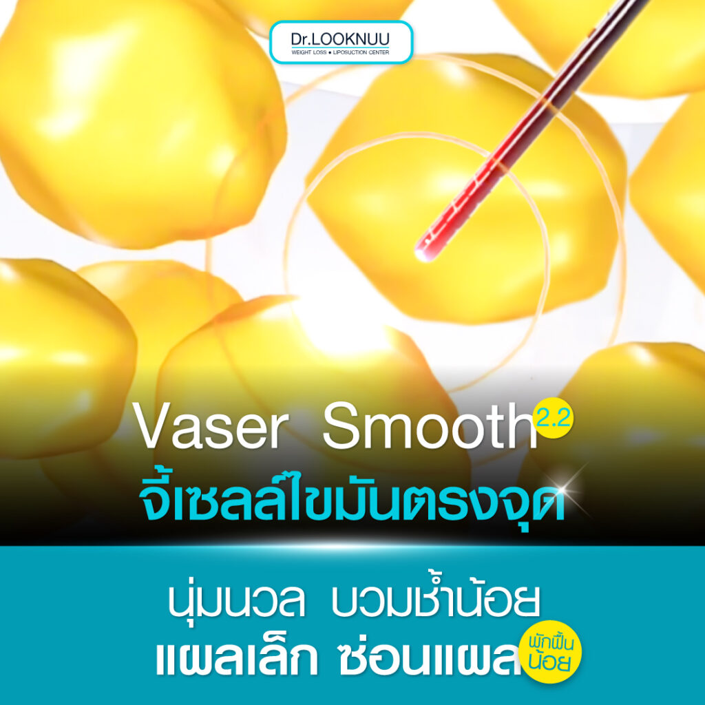 Vaser Smooth