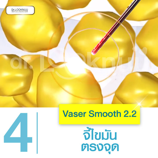 vaser smooth