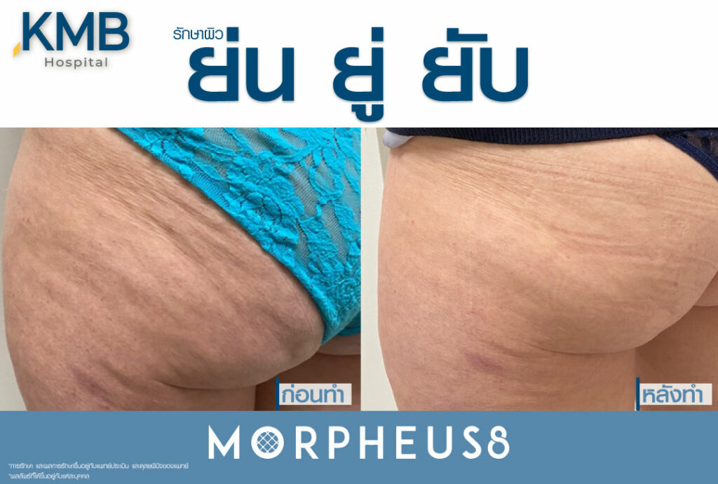 morpheus-หมอลูกหนู