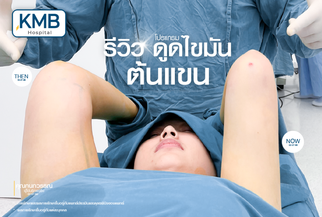 รีวิวดูดไขมันต้นแขน-หมอลูกหนู