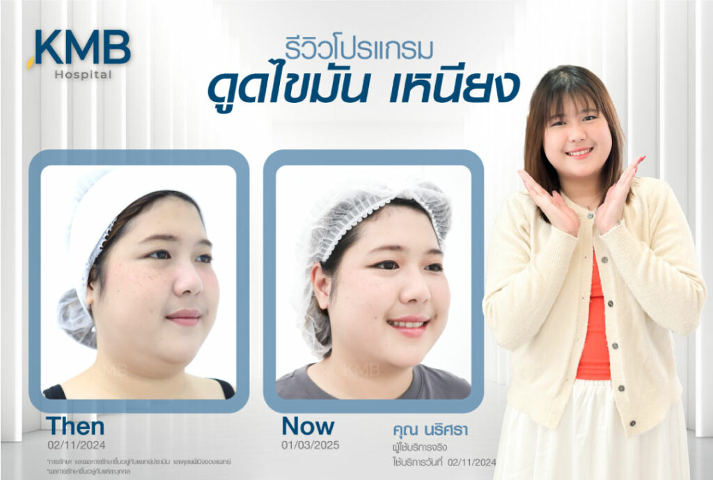 รีวิวดูดไขมันเหนียง-KMB