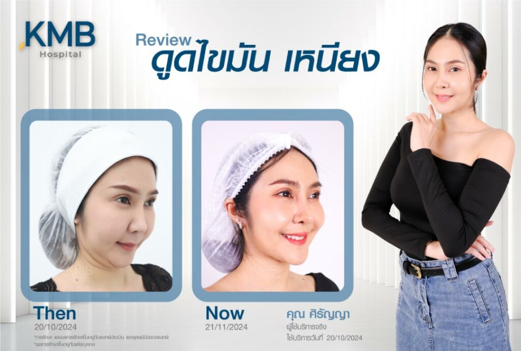 หมอลูกหนู-ดูดไขมันเหนียง-kmb