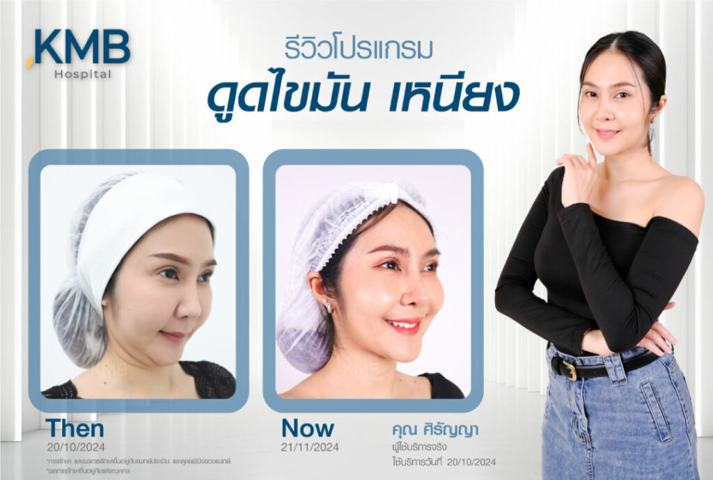 รีวิวดูดไขมันเหนียง-KMB