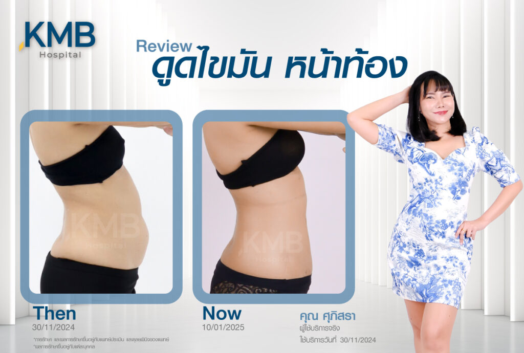 ดูดไขมันหน้าท้อง หมอลูกหนู