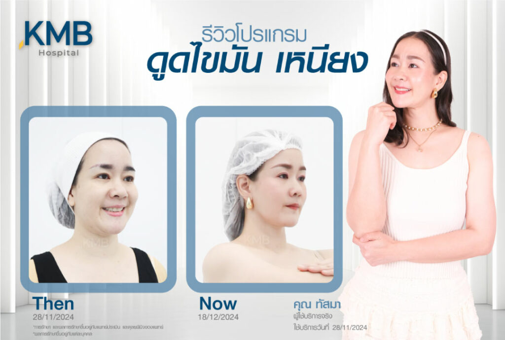 รีวิวดูดไขมันเหนียง-KMB