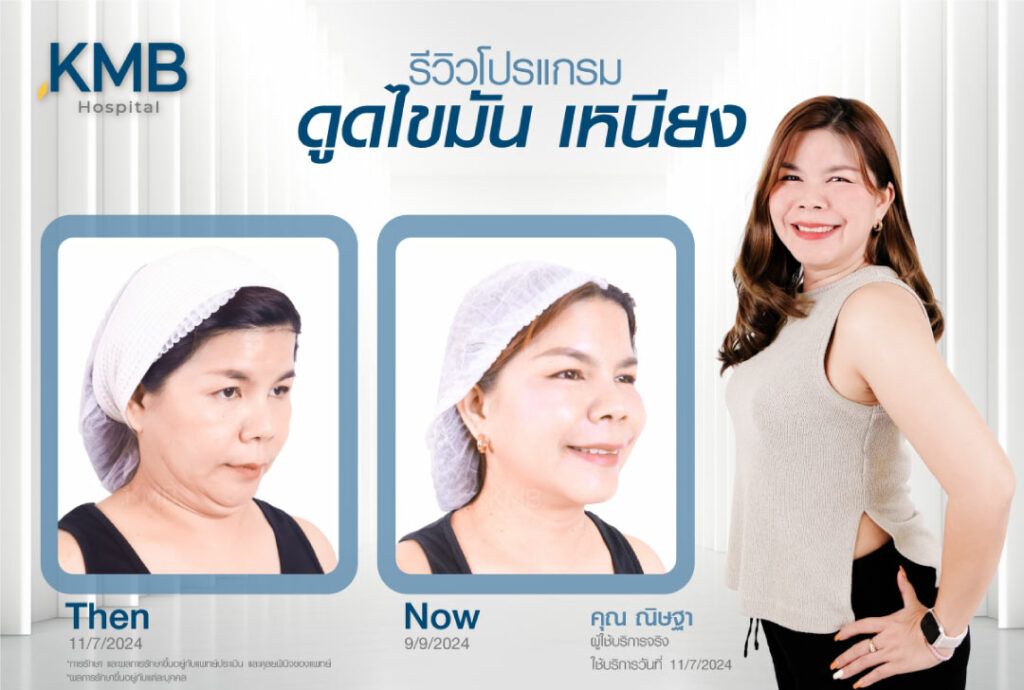 รีวิวดูดไขมันเหนียง-KMB