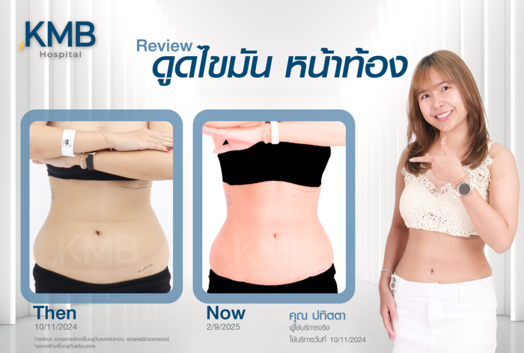 ดูดไขมันหน้าท้อง หมอลูกหนู