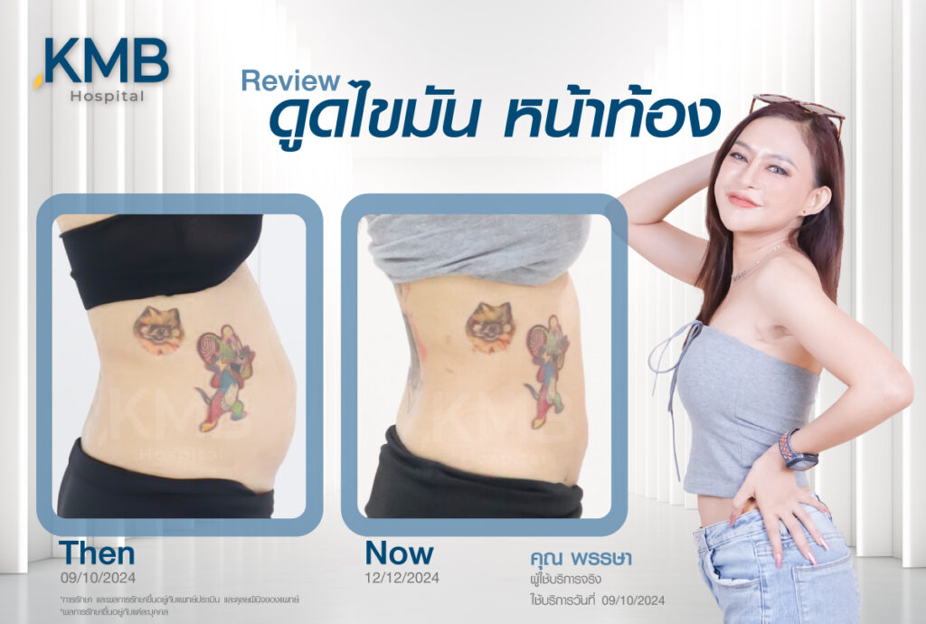 ดูดไขมันหน้าท้อง หมอลูกหนู