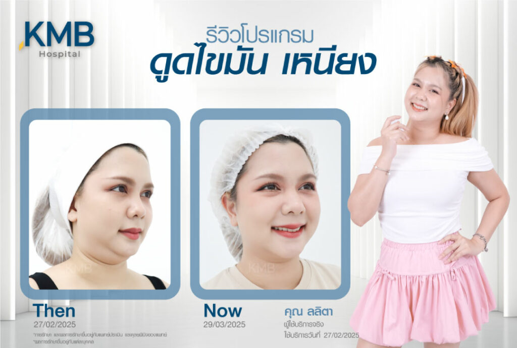 รีวิวดูดไขมันเหนียง-KMB