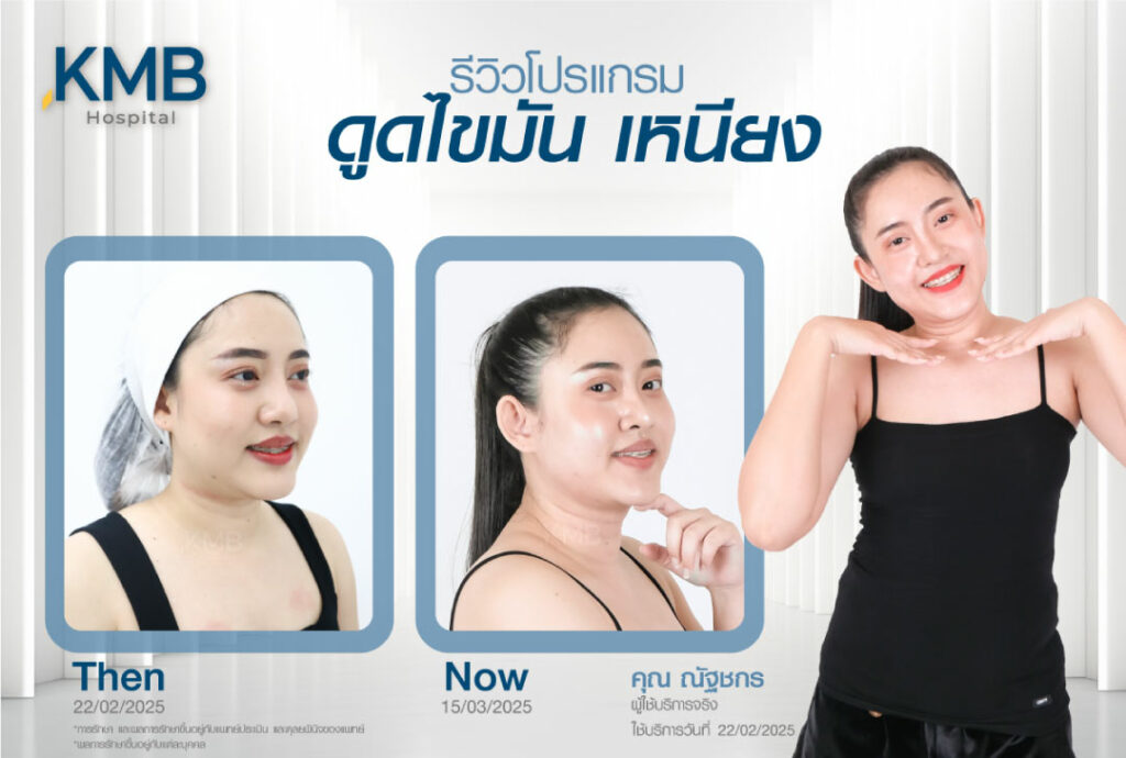 รีวิวดูดไขมันเหนียง-KMB