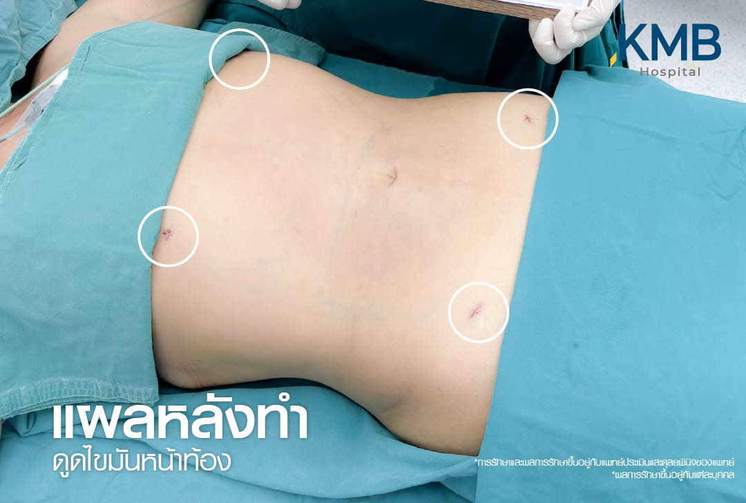 แผลหลังดูดไขมัน-KMB-หมอลูกหนู