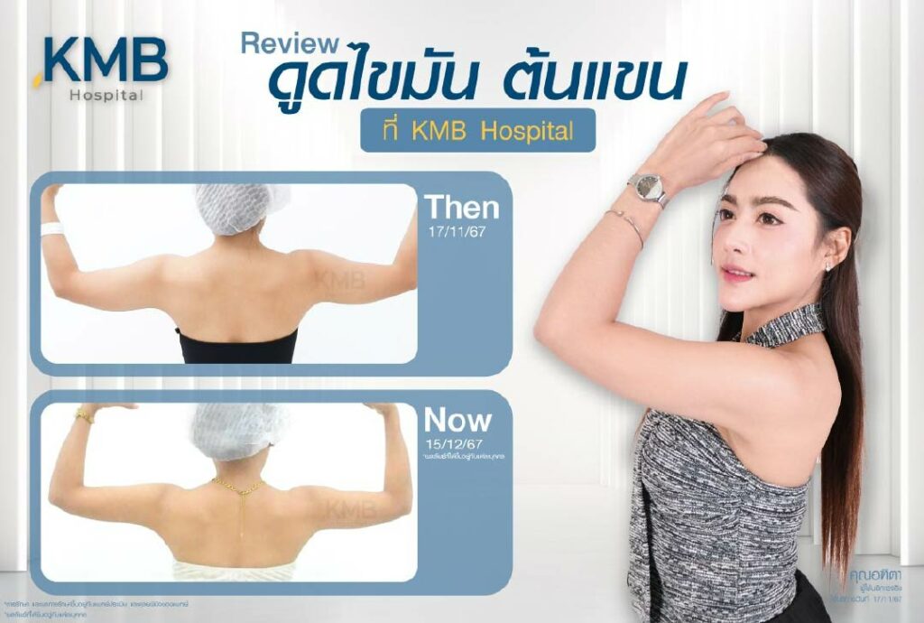 รีวิวดูดไขมัน-หมอลูกหนู-KMB