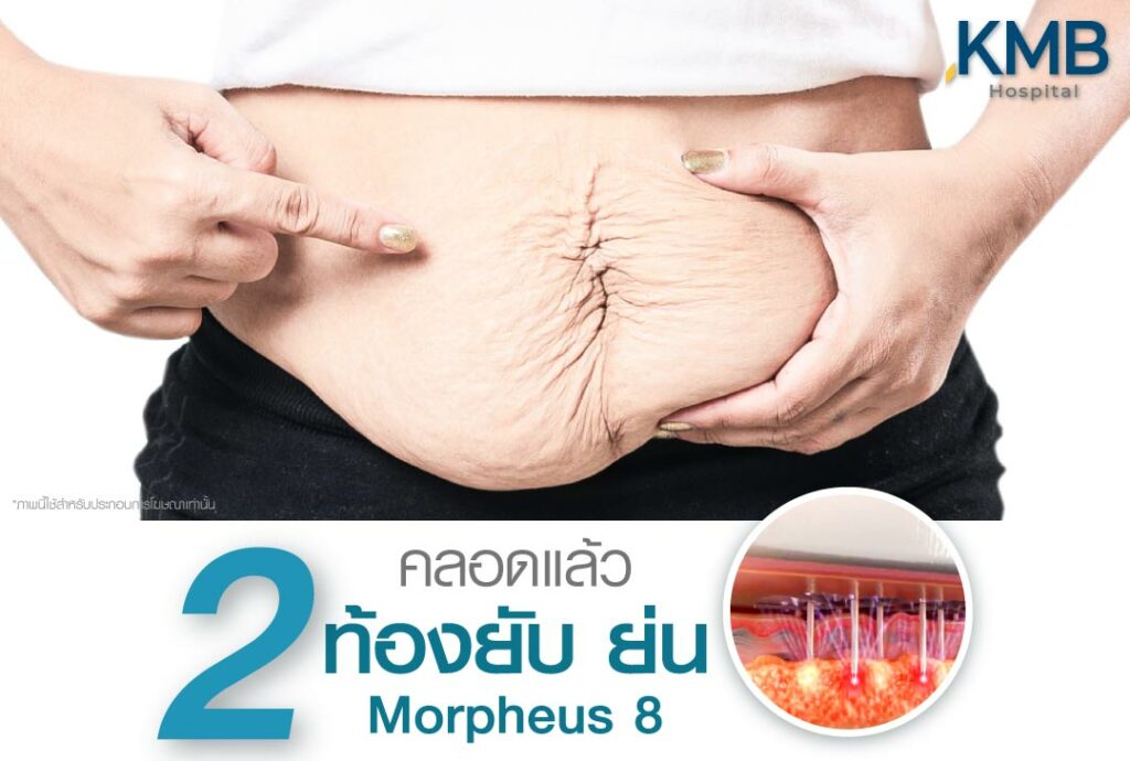ดูดไขมันหน้าท้อง หมอลูกหนู