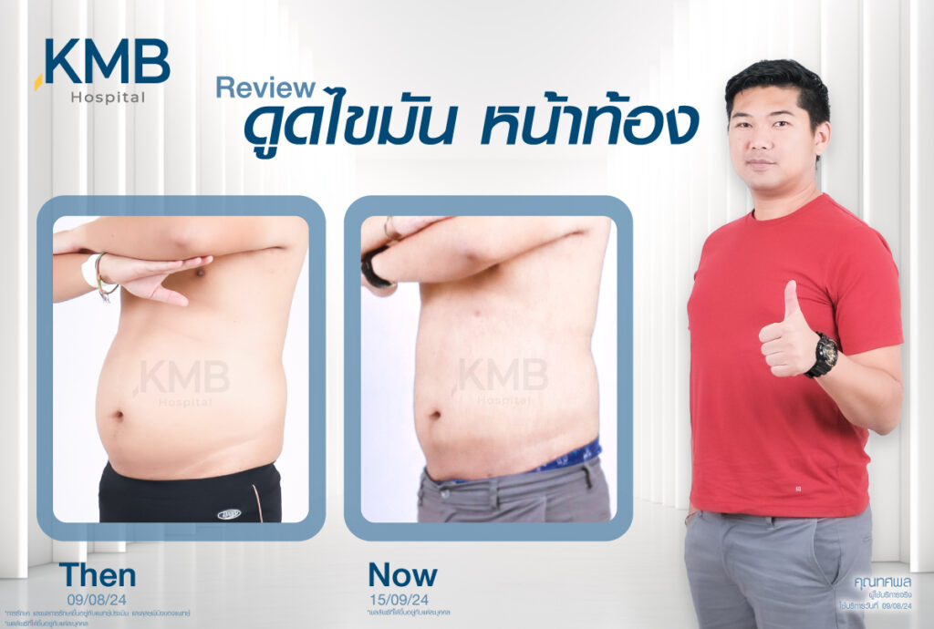 ดูดไขมันหน้าท้องผู้ชาย หมอลูกหนู