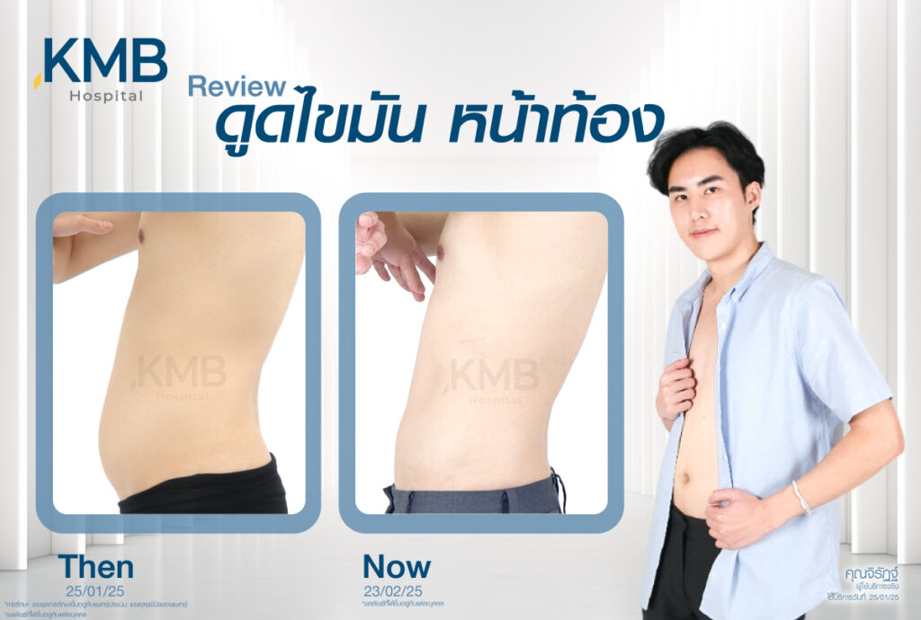 ดูดไขมันหน้าท้องผู้ชาย หมอลูกหนู