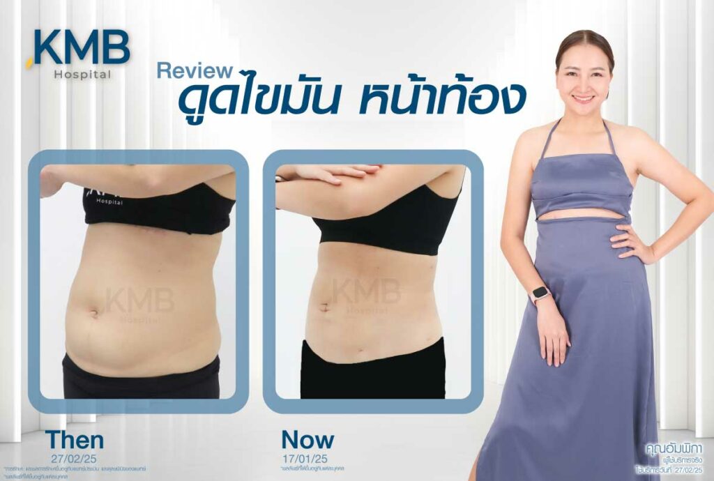 ดูดไขมันหน้าท้อง หมอลูกหนู