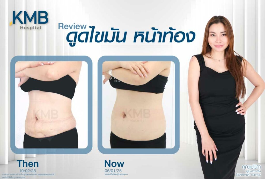 ดูดไขมันหน้าท้อง หมอลูกหนู