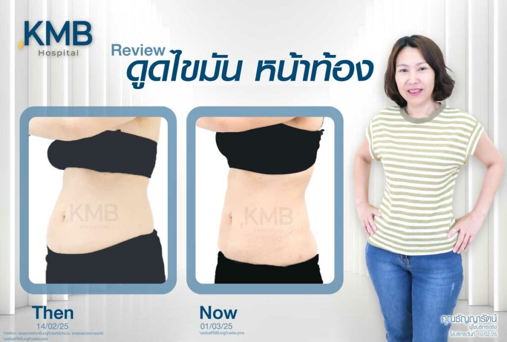 ดูดไขมันหน้าท้อง หมอลูกหนู