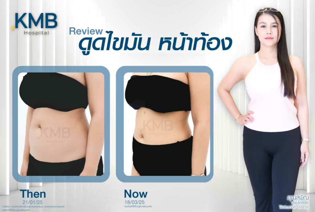 ดูดไขมันหน้าท้อง หมอลูกหนู
