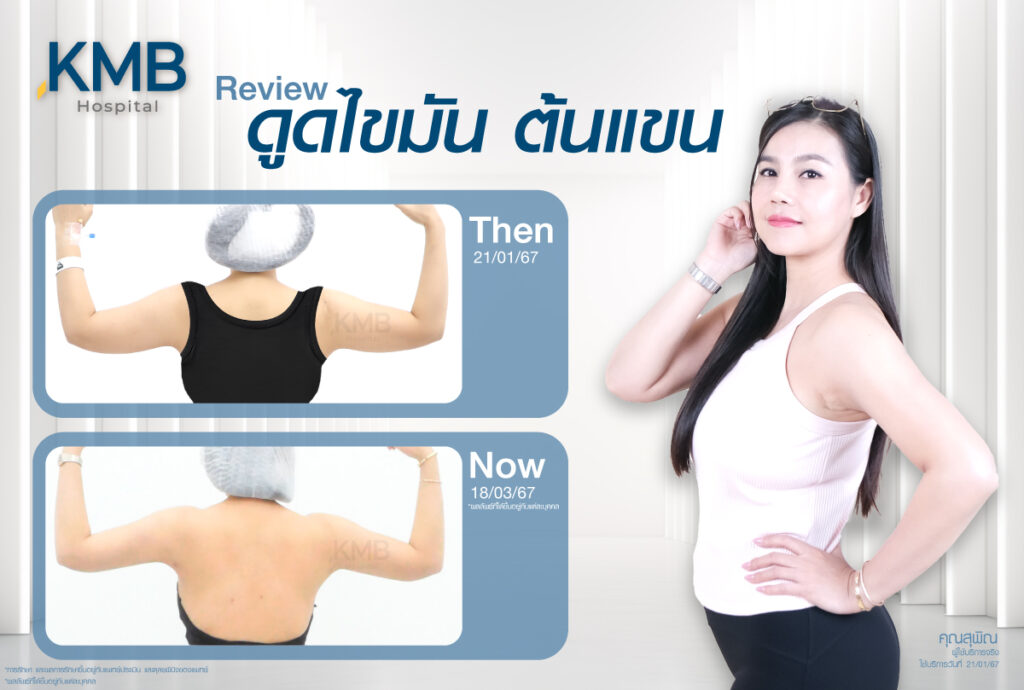 รีวิวดูดไขมัน-หมอลูกหนู-KMB
