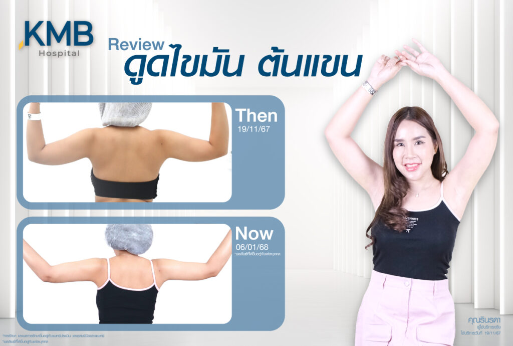 รีวิวดูดไขมัน-หมอลูกหนู-KMB