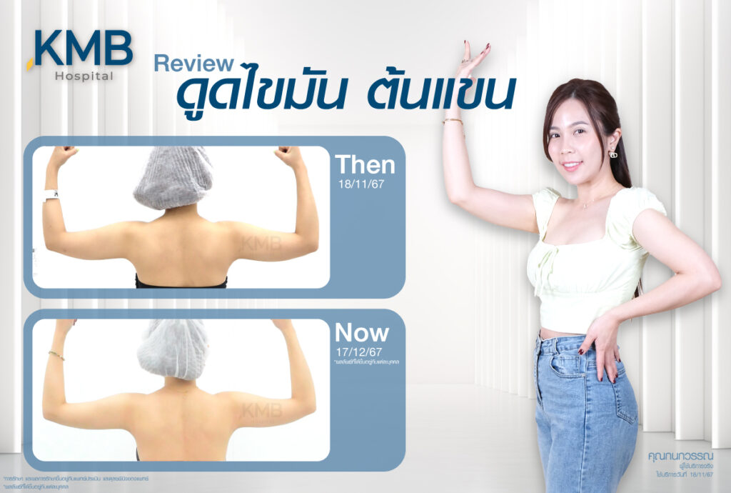 รีวิวดูดไขมัน-หมอลูกหนู-KMB