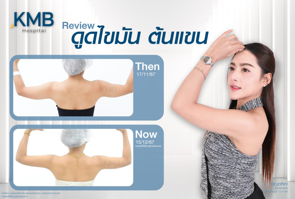 รีวิวดูดไขมัน-หมอลูกหนู-KMB