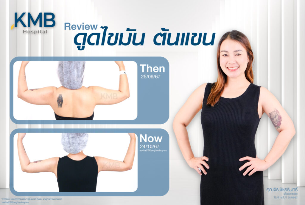 รีวิวดูดไขมัน-หมอลูกหนู-KMB