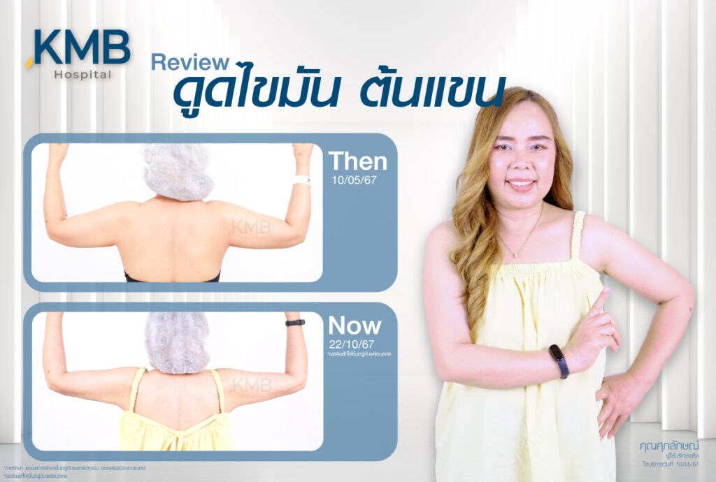 รีวิวดูดไขมัน-หมอลูกหนู-KMB