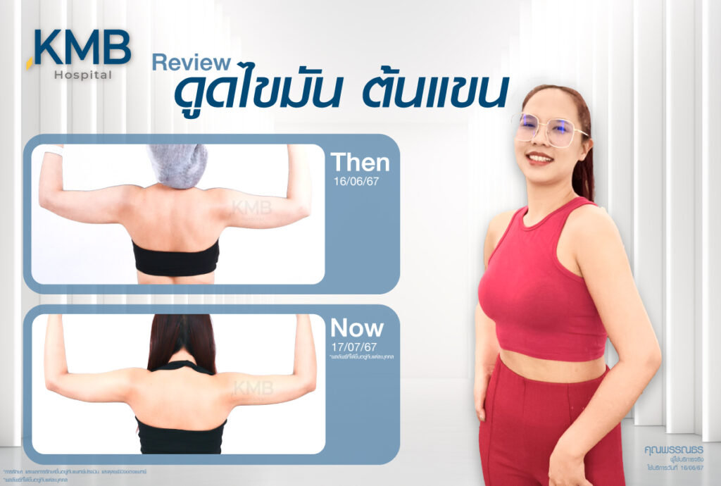 รีวิวดูดไขมัน-หมอลูกหนู-KMB