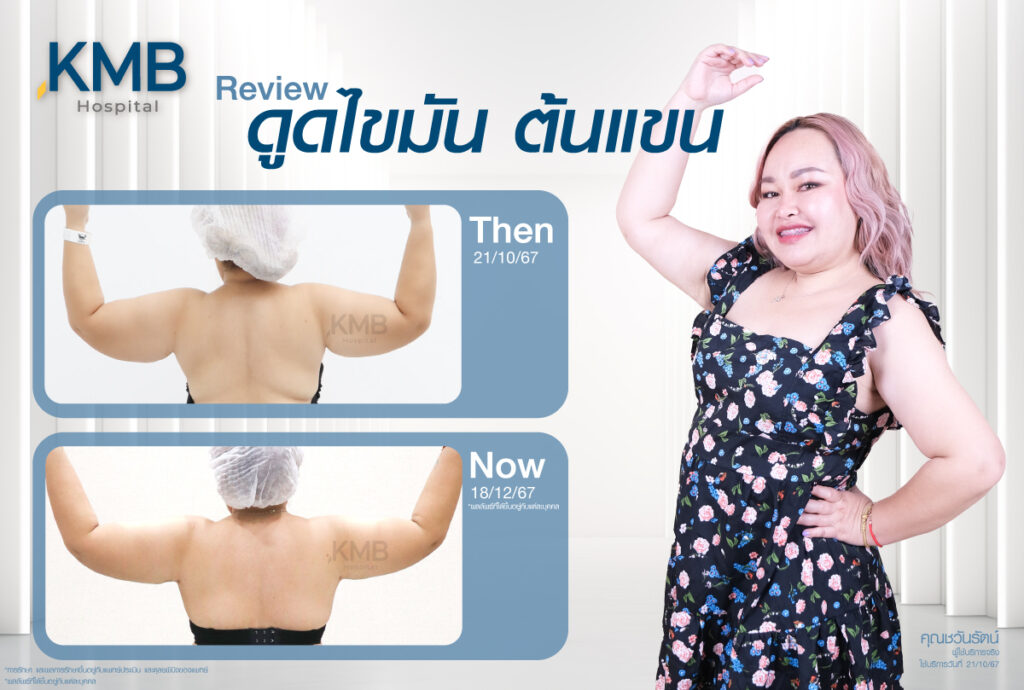 รีวิวดูดไขมัน-หมอลูกหนู-KMB